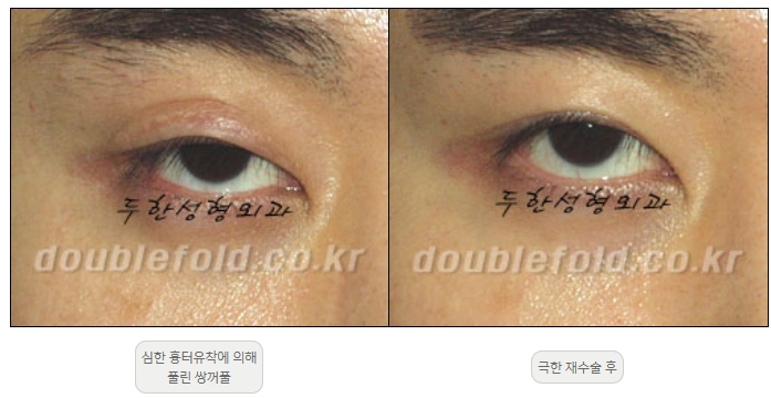 [Duhan Plastic Surgery Double Eyelid Revision] - [Thick Double Eyelid Line] image 58