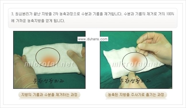[두한성형외과 경쟁력 미세지방이식] - [귀족수술과 인디언밴드 교정 안내] 관련 이미지 4