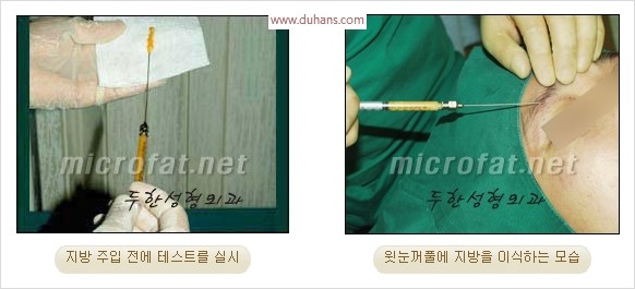 [두한성형외과 경쟁력 눈성형 리더] - [윗눈꺼풀 함몰( #꺼진눈꺼풀) 미세지방이식과 상안검성형]#꺼진눈성형 , #눈위함몰 관련 이미지 7