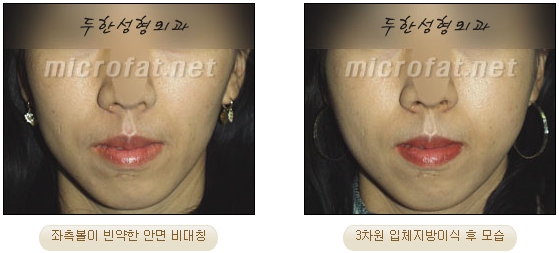 얼굴지방이식 두한성형외과 - 볼지방이식 관련 이미지 28