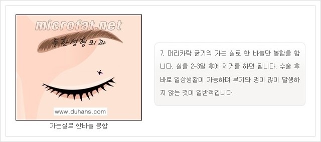 [두한성형외과 경쟁력 지방제거] - [눈밑지방제거, 눈위(윗눈꺼풀)지방제거 안내] 관련 이미지 11