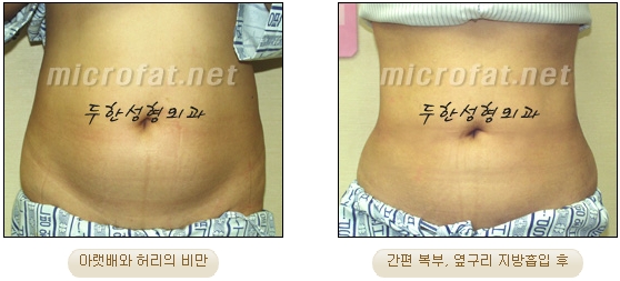 두한성형외과 지방흡입 - 부위별 안전 지방흡입 관련 이미지 17