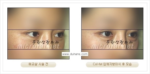 [두한성형외과 경쟁력 미세지방이식] - [상표등록 "Col-fat(콜펫) 지방이식"의 장점 안내] 관련 이미지 6
