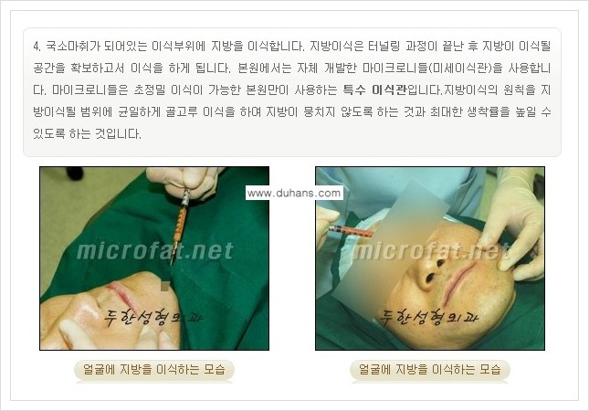 [두한성형외과 경쟁력 지방이식] - [지방이식 부작용 교정 안내 2.] 관련 이미지 8