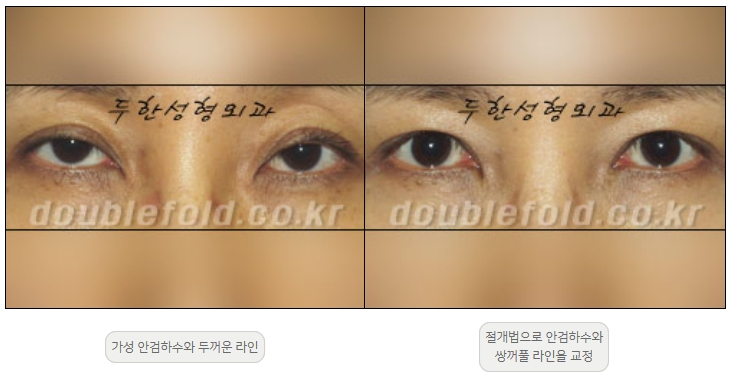 [Ptosis, Duhan Plastic Surgery] - [Sleepy-Looking Eyes, Ptosis Eye Correction] image 20