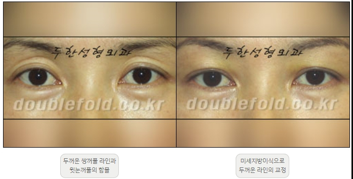 [Duhan Plastic Surgery Double Eyelid Revision] - [Thick Double Eyelid Line] image 24