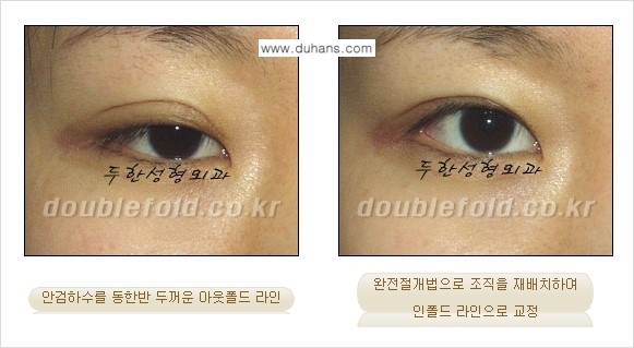 [두한성형외과 경쟁력 쌍꺼풀 재수술, 극한 눈재수술] - [심한 아웃폴드 라인을 인폴드 라인으로 교정 방법 안내] 관련 이미지 2