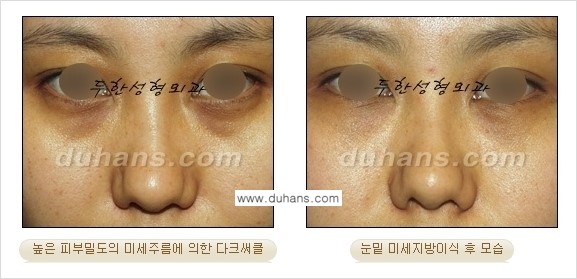 [두한성형외과 상큼하고 환한 눈매완성] - [눈밑 미세지방이식 ①] 관련 이미지 14