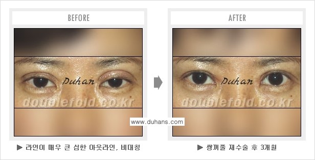 [두한성형외과 경쟁력 쌍꺼풀 재수술, 극한 재수술] - [쌍꺼풀 재수술로 인해 흉살이 두터운 경우] 관련 이미지 5