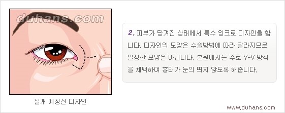 [두한성형외과 경쟁력 눈성형] - [흉터없는 몽고주름 제거 - 앞트임 수술 안내] 관련 이미지 10
