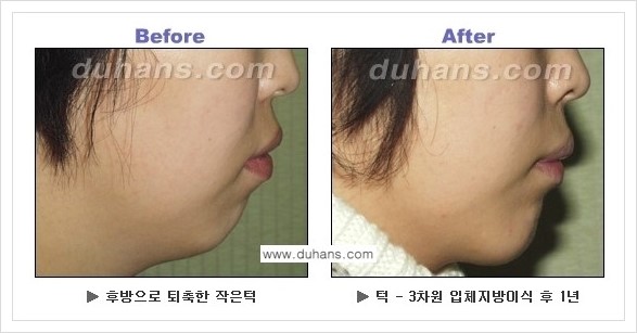 [두한성형외과 경쟁력 미세지방이식] - [아름다운 얼굴선 - 무턱, 오목턱, 비대칭턱 지방이식 안내] 관련 이미지 12