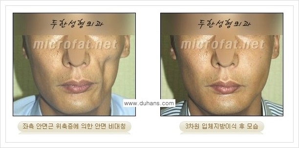 [두한성형외과 경쟁력 볼살지방이식] - [사각턱의 경우, 측면 볼살의 함몰선, 안면비대칭, 남성 야윈볼살 안내] 관련 이미지 11