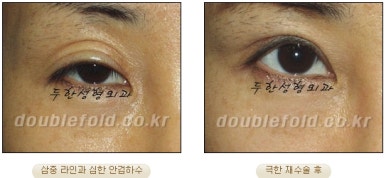 쌍꺼풀수술 두한성형외과 - 쌍커풀재수술의 문제점 관련 이미지 35