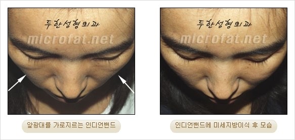 지방이식 두한성형외과 - 입가팔자주름, 인디언주름 지방이식 관련 이미지 32