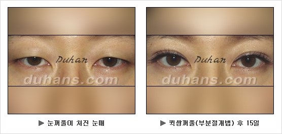[두한성형외과 경쟁력 눈성형] - [눈성형 방법에 대한 흔한 질문과 답변 안내] 관련 이미지 3