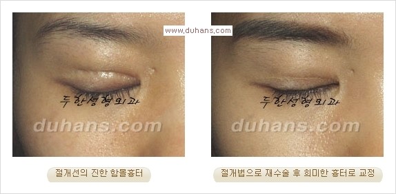 [두한성형외과 경쟁력 쌍꺼풀 재수술, 극한 눈재수술] - [절개법 수술후 쌍꺼풀 흉터선이 진한 경우의 교정 안내] 관련 이미지 3