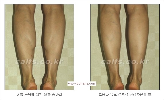 ⁠[두한성형외과 경쟁력 종아리성형] - [종아리퇴축술 - 비절개 초음파 유도 선택적 신경차단술 장비 안내] 관련 이미지 11