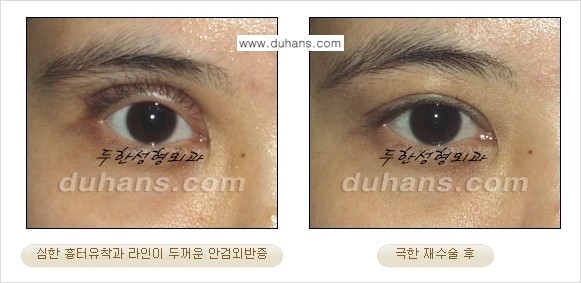 [두한성형외과 경쟁력 눈성형] - [두꺼운 라인을 교정하는 극한 눈 재수술 1.] 관련 이미지 14