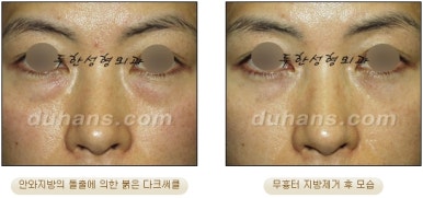 [두한성형외과 지방제거] - [눈두덩이지방제거, 눈밑지방제거] 관련 이미지 23