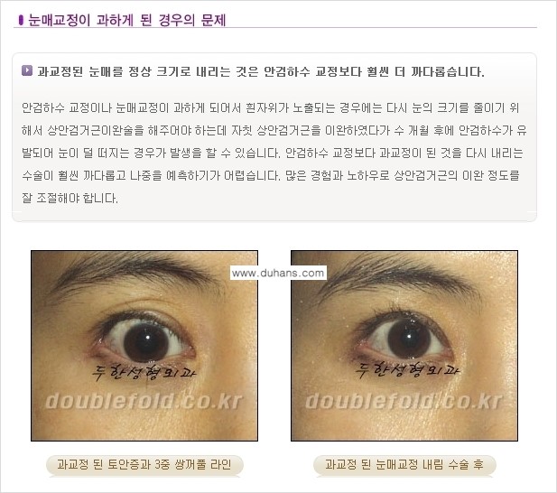[두한성형외과 경쟁력 있는 쌍꺼풀 재수술] - [극복해야 할 극한의 상황과 문제들] 관련 이미지 11