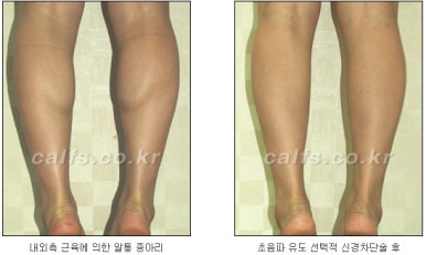 ​[두한성형외과 종아리수술] - [나에게 맞는 종아리성형방법] 관련 이미지 19