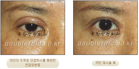 [DoubleFold Plastic Surgery Eye Surgery] - [Revision Surgery for Thick Double Eyelids] image 39