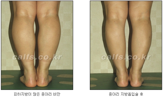 두한성형외과 지방흡입 - 부위별 안전 지방흡입 관련 이미지 32