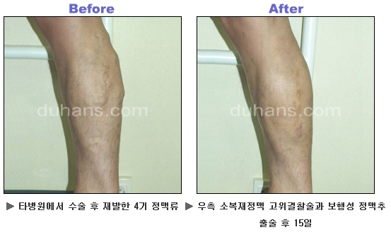 [두한성형외과 정맥류] - [하지정맥류, 정맥확장증, 혈관확장증] 관련 이미지 40