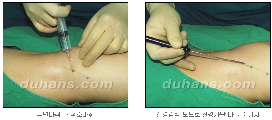 [두한성형외과 종아리축소술] - [초음파 유도 선택적 신경차단술 안내] 관련 이미지 10