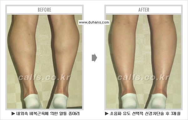 [두한성형외과 경쟁력 멀티종아리성형] - [종아리성형 전후 주의해야 할 내용 안내] 관련 이미지 15