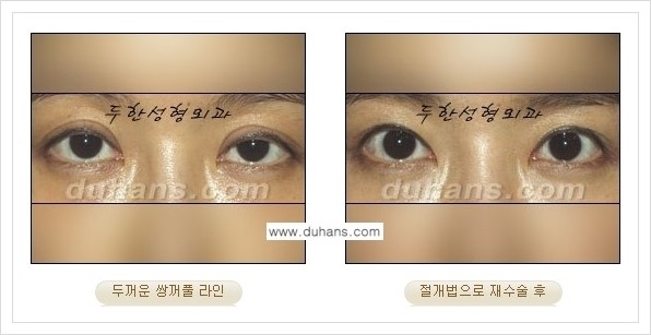 [두한성형외과 경쟁력 쌍꺼풀 재수술, 극한 재수술] - [두꺼운 쌍꺼풀 라인의 교정 방법 안내] 관련 이미지 4