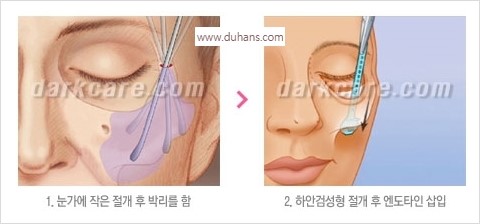 [두한성형외과 경쟁력 주름성형] - [주름제거와 볼륨을 갖게하는 엔도타인 리프팅] 관련 이미지 31