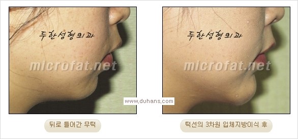 ⁠⁠[두한성형외과 경쟁력 미세지방이식] - [턱 미세지방이식 - 안면윤곽 교정 안내] 관련 이미지 19