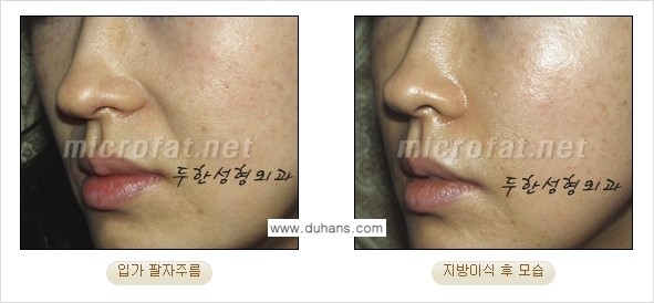 [두한성형외과의 경쟁력 있는 지방이식] - [입가주름, 팔자주름 미세지방이식 1.] 관련 이미지 12