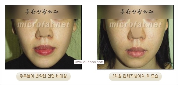[두한성형외과 경쟁력 미세지방이식] - [볼살, 이마, 측두부 - 안면윤곽 미세지방이식] 관련 이미지 8