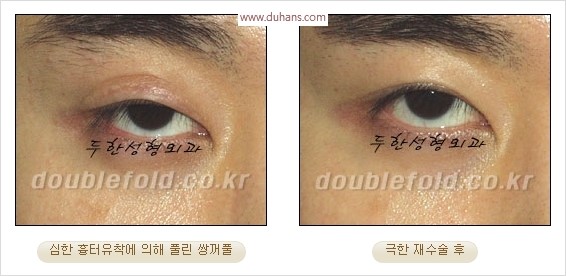 [두한성형외과 경쟁력 눈성형] - [극한 재수술, 함몰된 눈꺼풀 라인교정, 안검하수(졸리운 눈매)] 관련 이미지 29
