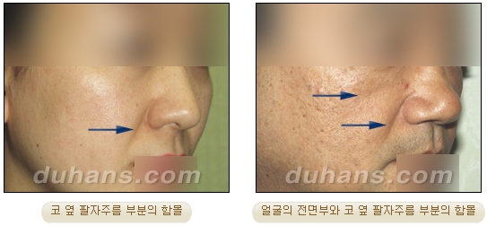[두한성형외과 얼굴자가지방이식] - [귀족수술 입체 미세지방이식] 관련 이미지 3