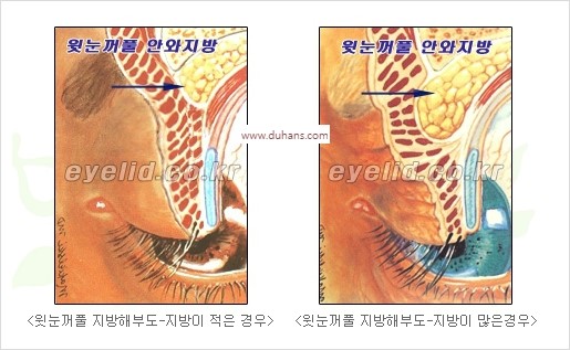 [두한성형외과 경쟁력 안검성형] - [젊은 눈매 안검성형의 여러 가지 방법 안내] 관련 이미지 99