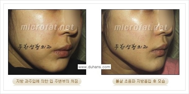 [두한성형외과 겨울엔 지방흡입을] - [볼살, 눈밑, 턱선의 초음파 미세지방흡입 1.] 관련 이미지 3