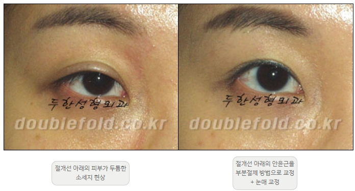 [Double Eyelid Surgery Duhan Plastic Surgery] - [Revision Methods] image 17