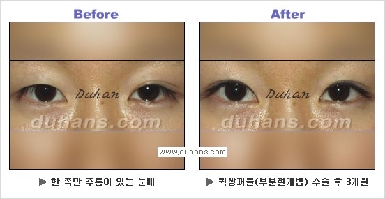 ​[두한성형외과 경쟁력 눈성형] - [자연스럽고 아름다운 쌍꺼풀의 기준] 관련 이미지 27