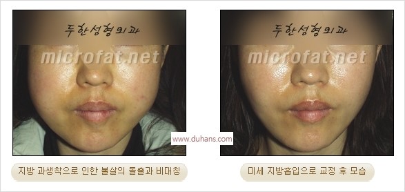 [두한성형외과 경쟁력 윤곽성형] - [볼, 볼살 지방이식] 관련 이미지 41