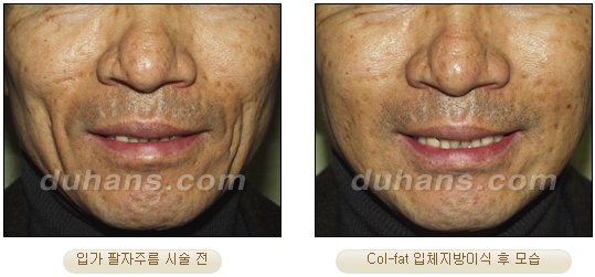 [Duhan Plastic Surgery Facial Autologous Fat Grafting] - [Fat Grafting Guide] image 28