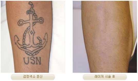 Duhan Plastic Surgery Laser Treatment - Mole Removal, Spot Removal, Melasma, Blemishes, Hyperpigmentation, Skin Tone Improvement, Elasticity Improvement, Skin Texture Improvement image 26