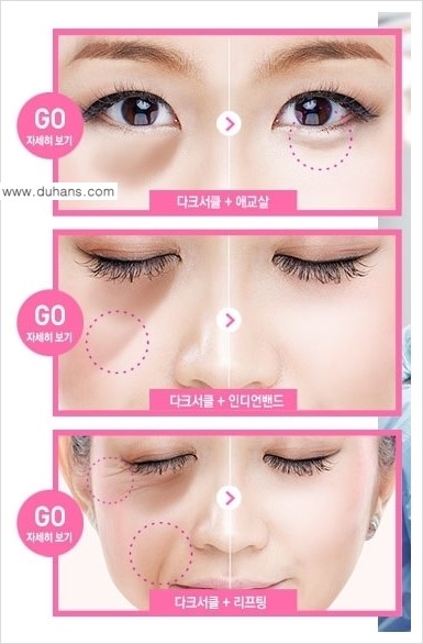 [두한성형외과 경쟁력 다크써클 치료] - [다크써클 5단계로 이뤄지는 핵심 5 STEP SOLUTION 안내 2.] 관련 이미지 4