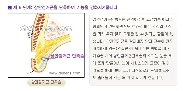 [두한성형외과 경쟁력 눈성형] - [쌍꺼풀 재수술 방법 - 완전절개법(Full incision method) 과정 안내] 관련 이미지 7