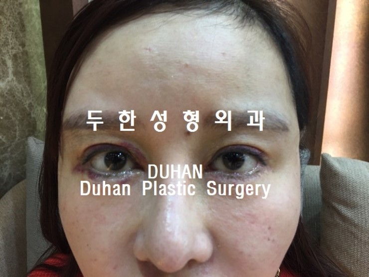 #쌍꺼풀재수술 지방전진 #재배치 를 통해 라인 자연스럽게 낮추기, #눈재수술 #인라인 관련 이미지 3