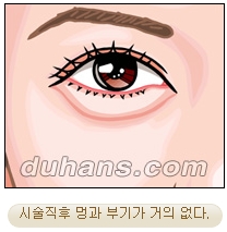 두한성형외과 지방제거 - 눈밑지방, 눈꺼풀지방제거 관련 이미지 19