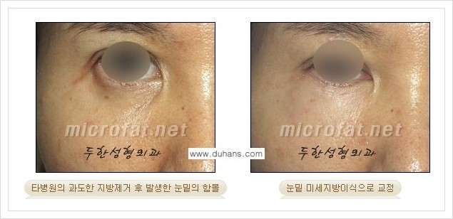 [두한성형외과 경쟁력 지방제거] - [눈밑(눈위)지방제거, 눈꺼풀(윗눈꺼풀)지방제거 안내 ②] 관련 이미지 4