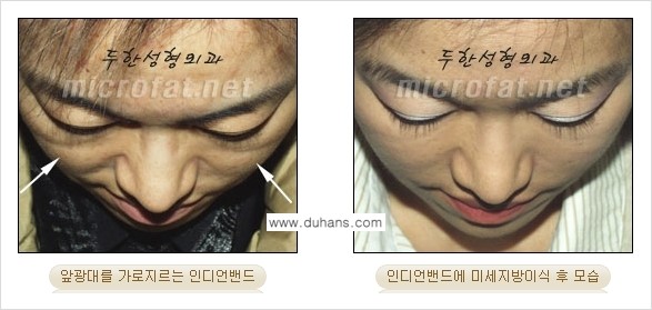 [두한성형외과의 경쟁력 미세지방이식] - [귀족수술과 인디언밴드 미세지방이식 안내 ③] 관련 이미지 10